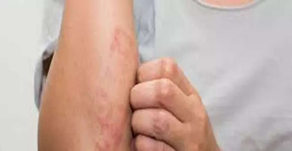 असम में लेप्टोस्पायरोसिस: बढ़ती चिंता और स्वास्थ्य जोखिम