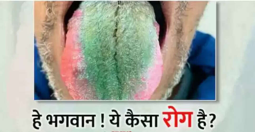 अमेरिका में जीभ पर बाल उगने का अनोखा मामला