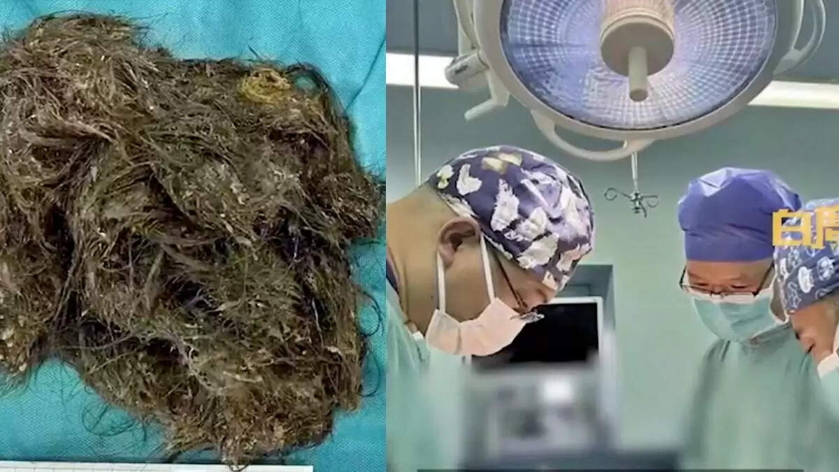 15 वर्षीय लड़की के पेट से निकला 2 किलोग्राम बालों का गुच्छा