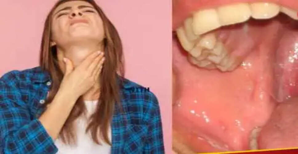 टॉन्सिलिटिस: लक्षण, कारण और उपचार की जानकारी