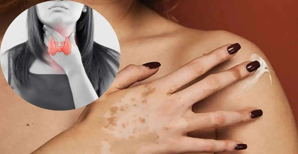विटिलिगो और थायरॉइड रोग: स्वास्थ्य संबंधी महत्वपूर्ण जानकारी