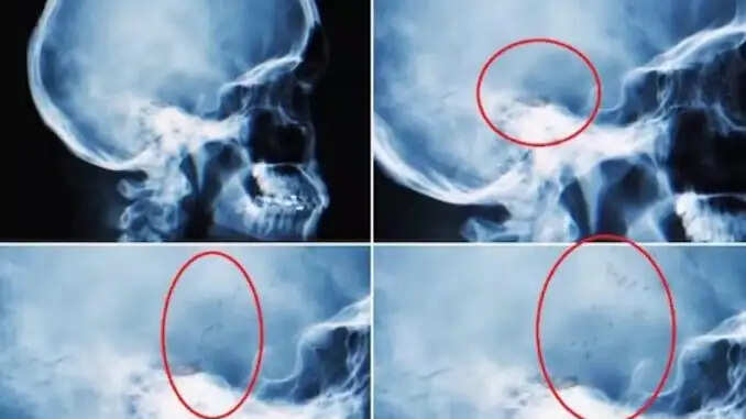 सिर में कीड़े का अजीब एक्स-रे: डॉक्टरों ने की इमरजेंसी सर्जरी की सलाह