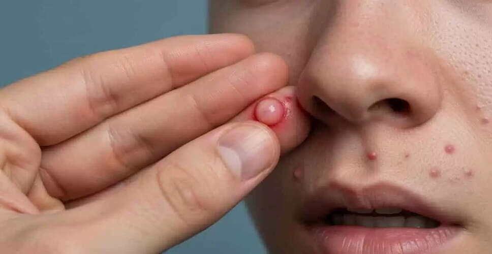 चेहरे के खतरनाक त्रिकोण: पिंपल फोड़ने से बचें