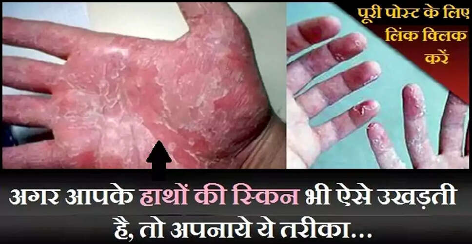 हाथों की स्किन उतरने की समस्या और उसके समाधान