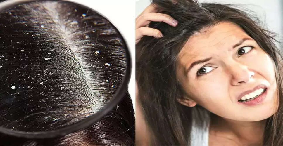 सर्दियों में डैंड्रफ से राहत पाने के लिए प्राकृतिक उपाय