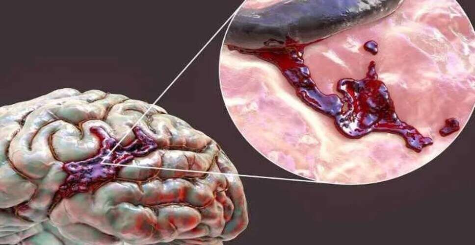 गर्मी में दिमाग की नसें क्यों फटती हैं? जानें बचाव के उपाय