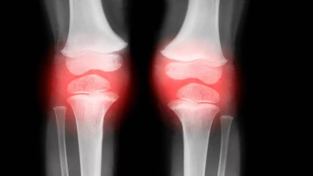 कमजोर हड्डियों के कारण और बचाव के उपाय