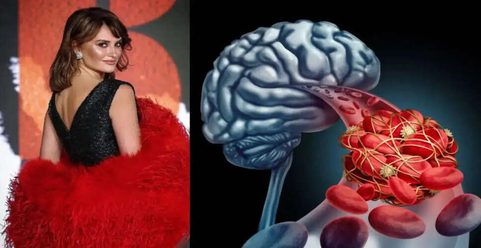 पेनलोप क्रूज़ का स्वास्थ्य संकट: मस्तिष्क एनीरिज्म के लक्षण और चेतावनी संकेत