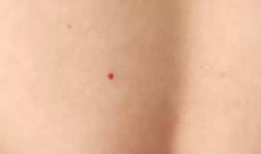 सामुद्रिक शास्त्र: लाल तिल का महत्व और संकेत