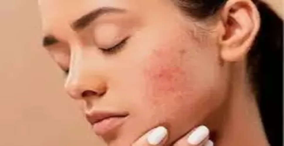 मुहांसों से छुटकारा पाने के लिए हल्दी का उबटन: जानें इसके फायदे और बनाने की विधि