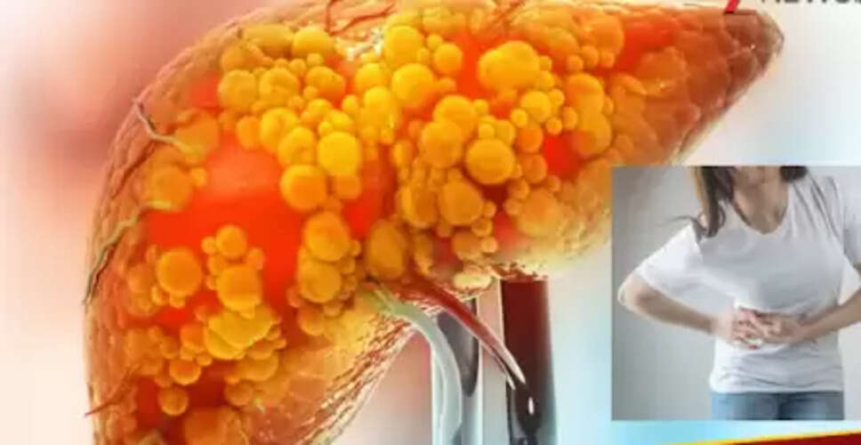 29 वर्षीय युवती में फैटी लिवर की गंभीर स्थिति, डॉक्टरों को हुआ आश्चर्य