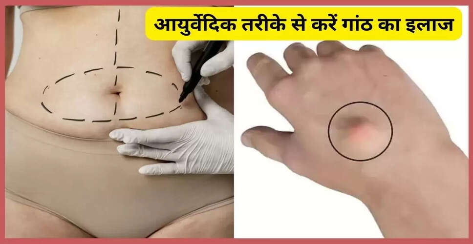 गांठों का उपचार: लिपोमा और आयुर्वेदिक उपाय