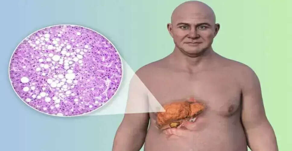फैटी लिवर: लक्षण, कारण और बचाव के उपाय