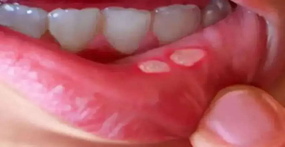 मुंह के छालों से राहत पाने के सरल घरेलू उपाय