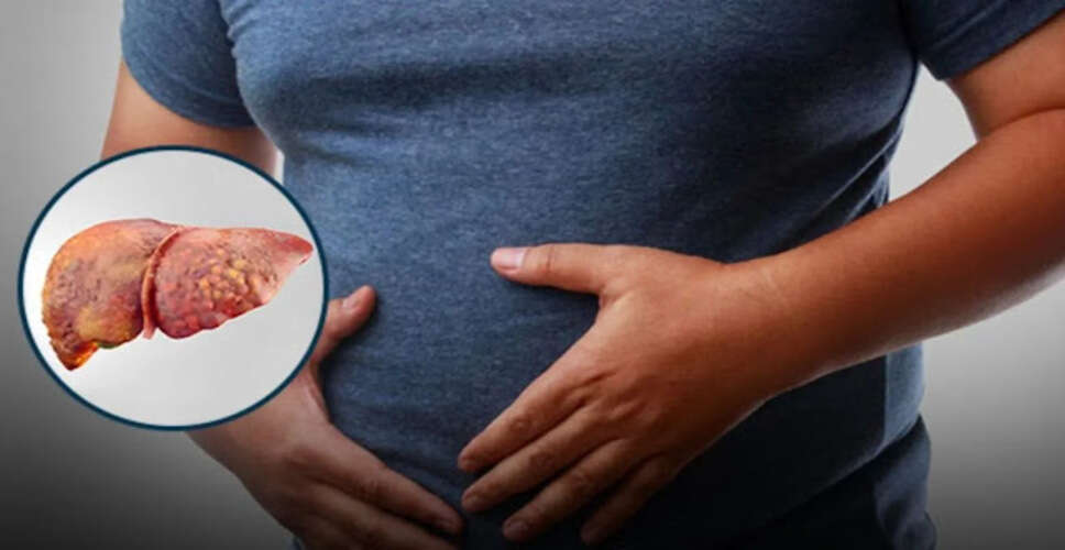 फैटी लिवर से राहत पाने के लिए प्राकृतिक उपाय