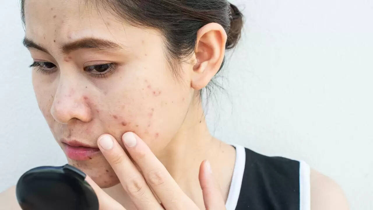 चेहरे पर दाने निकलने के कारण और बचाव के उपाय
