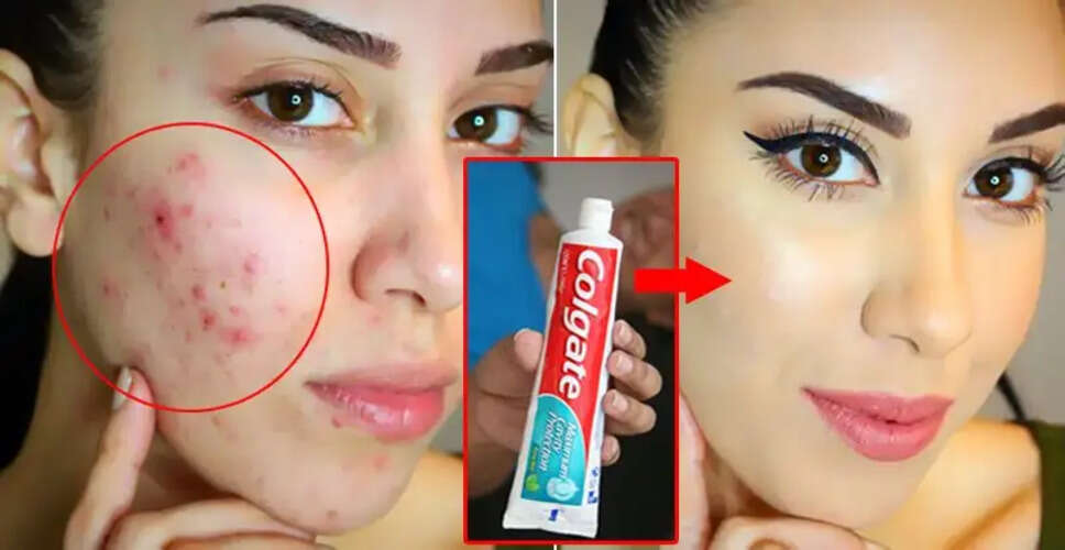 मुंहासों से तुरंत राहत पाने के लिए टूथपेस्ट का उपयोग