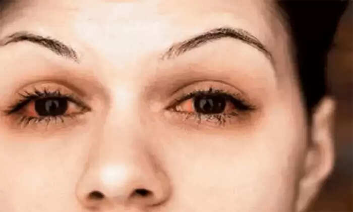 आंखों में पानी आने के 6 प्रमुख कारण और उनके समाधान