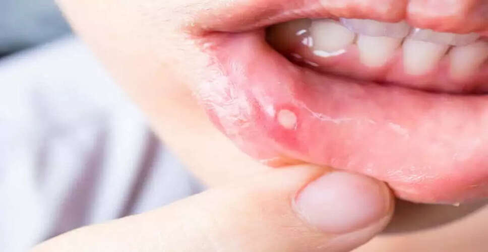 तुलसी के पत्तों से मुंह के अल्सर का प्रभावी उपचार