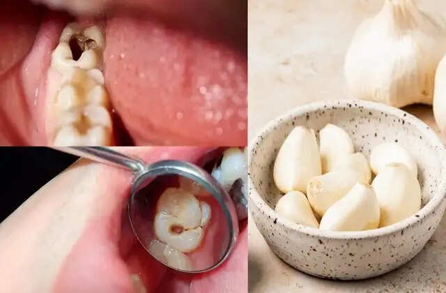दांतों की सड़न से छुटकारा पाने के लिए 5 प्रभावी घरेलू उपाय