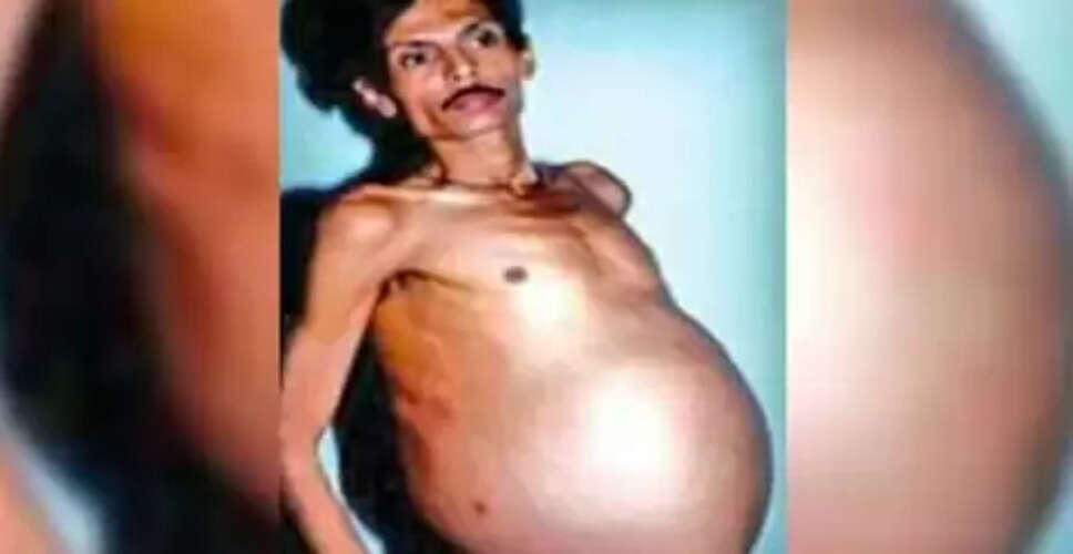 नागपुर में अनोखी चिकित्सा घटना: 36 साल तक फूला पेट और हैरान करने वाला सच्चाई