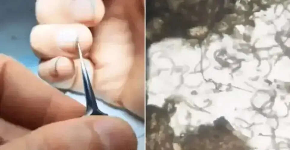 नाखून चबाने की आदत: स्वास्थ्य पर गंभीर प्रभाव