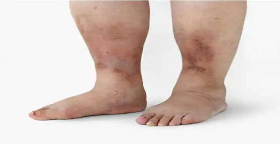 पैरों में 5 लक्षण जो डायबिटीज का संकेत हो सकते हैं