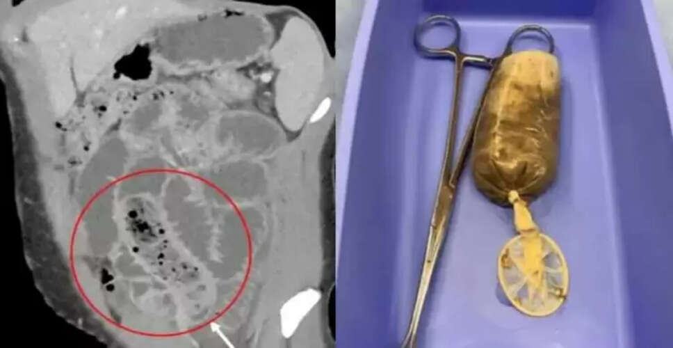 गुस्से में केला निगलने से हुई गंभीर समस्या: डॉक्टरों ने किया ऑपरेशन