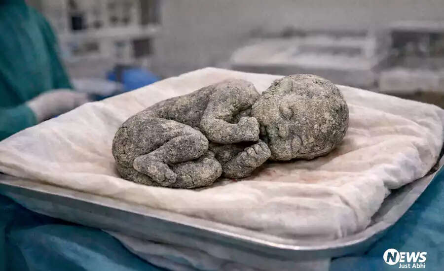 महिला के पेट में 15 साल तक रहा मृत भ्रूण, जानें लिथोपीडियन बीमारी के बारे में
