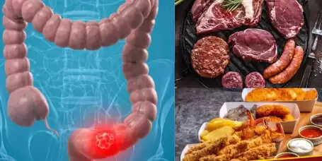 कोलोन कैंसर: जानें लक्षण, कारण और बचाव के उपाय
