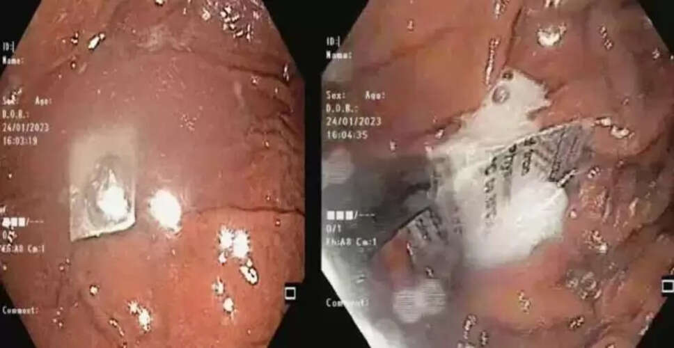 दिल्ली में मरीज के गले से निकाली गई एल्यूमीनियम फॉयल, डॉक्टरों ने बिना सर्जरी किया इलाज