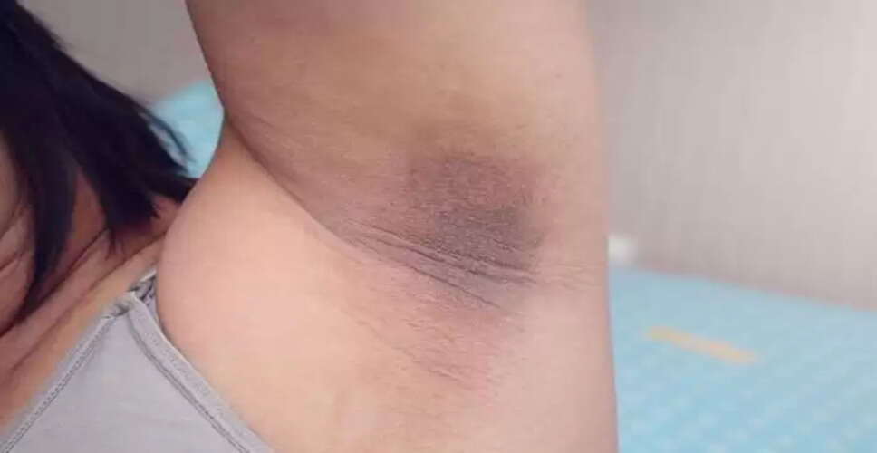 अंडरआर्म्स और जांघों के कालेपन को दूर करने के प्रभावी उपाय