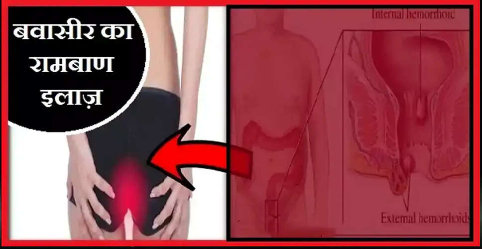 बवासीर के घरेलू उपचार: जानें कैसे पाएं राहत