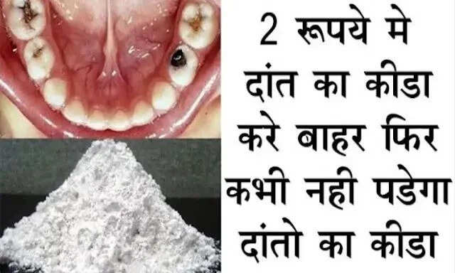 दांतों के कीड़ों को खत्म करने का आसान आयुर्वेदिक उपाय