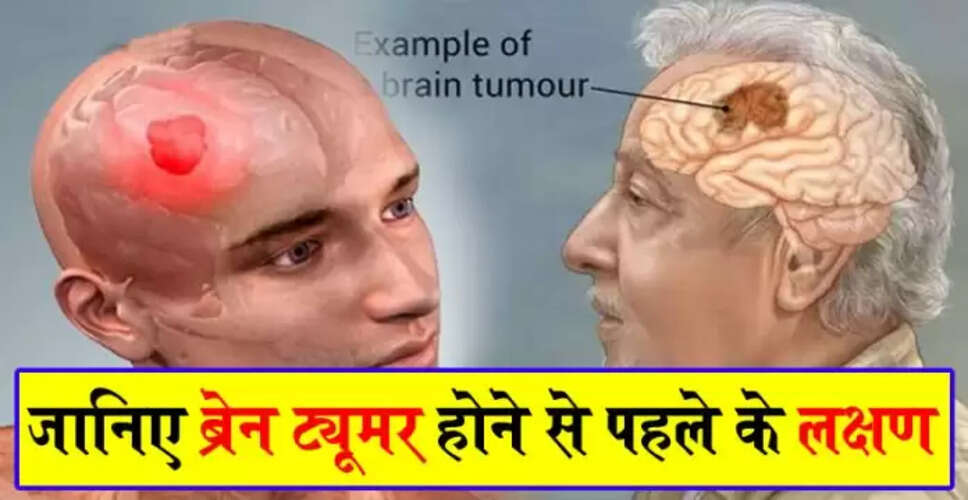 ब्रेन ट्यूमर के प्रारंभिक लक्षण: पहचानें और सावधान रहें