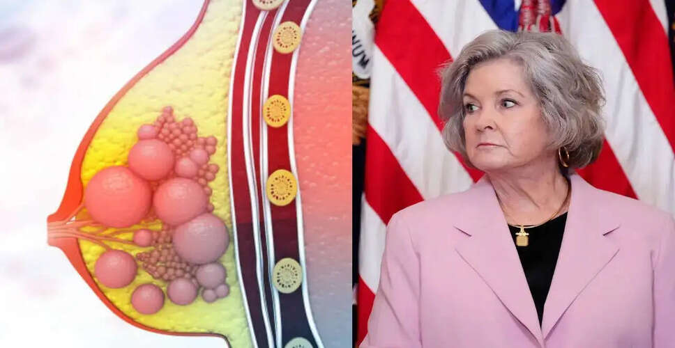 ब्रेस्ट कैंसर: प्रारंभिक पहचान और रोकथाम के महत्व पर चर्चा