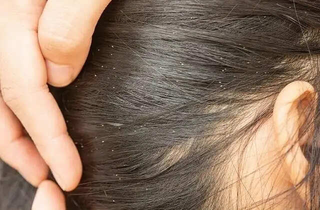 सिर में जुओं के संक्रमण से बचने के उपाय और सावधानियाँ