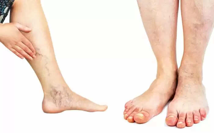 पैर की नस चढ़ने के कारण और उपाय: जानें कैसे पाएं राहत