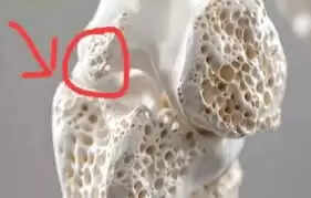 कैल्शियम की कमी से बचने के लिए किन खाद्य पदार्थों से करें परहेज