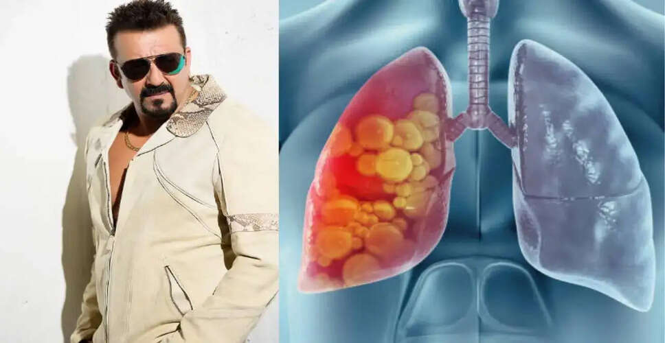 संजय दत्त का स्वास्थ्य पर ध्यान: कैंसर के बाद नियमित जांच का महत्व