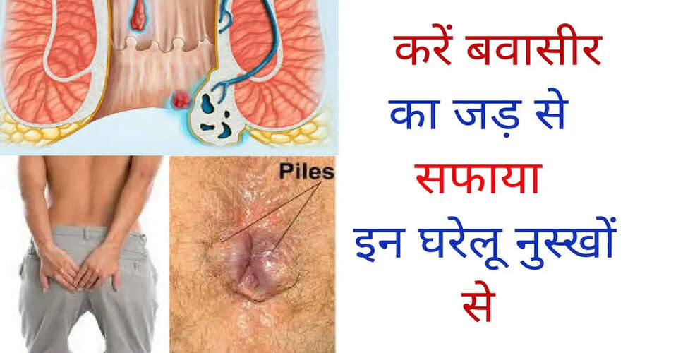बवासीर: प्रकार, लक्षण और घरेलू उपचार