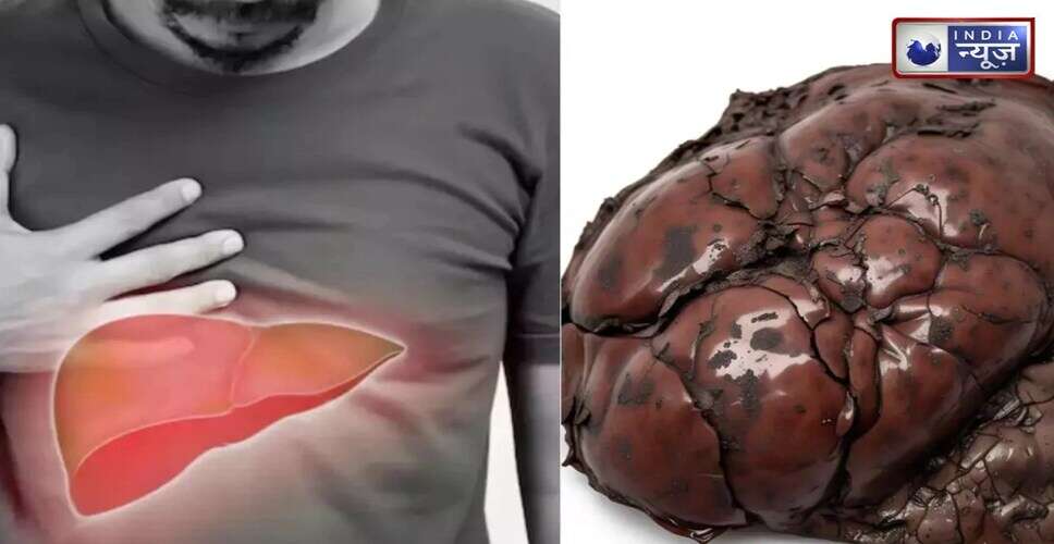 फैटी लिवर: स्वास्थ्य पर पड़ने वाले गंभीर प्रभाव और बचाव के उपाय