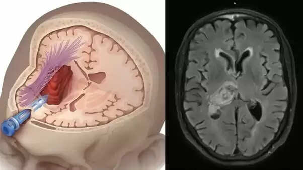 मिनी ब्रेन स्ट्रोक: लक्षण और बचाव के उपाय