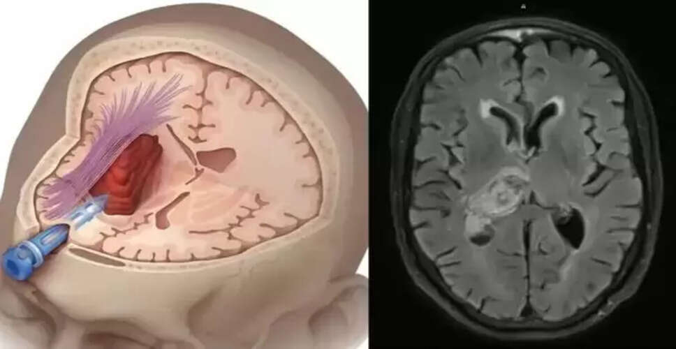 मिनी ब्रेन स्ट्रोक: लक्षण और बचाव के उपाय