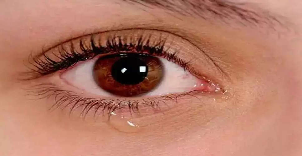 आँखों से पानी बहने की समस्या: घरेलू उपाय और देखभाल के टिप्स