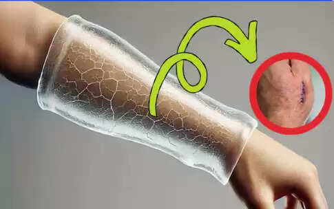 नवीनतम हाइड्रोजेल तकनीक: गंभीर घावों के उपचार में क्रांति