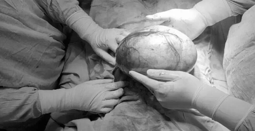 बुरहानपुर में जटिल सर्जरी से महिला को मिली नई जिंदगी