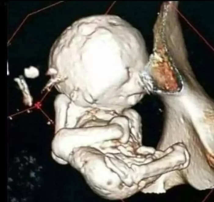 73 वर्षीय महिला के पेट में 35 साल पुराना भ्रूण, डॉक्टरों ने बताया 'बेबी स्टोन'