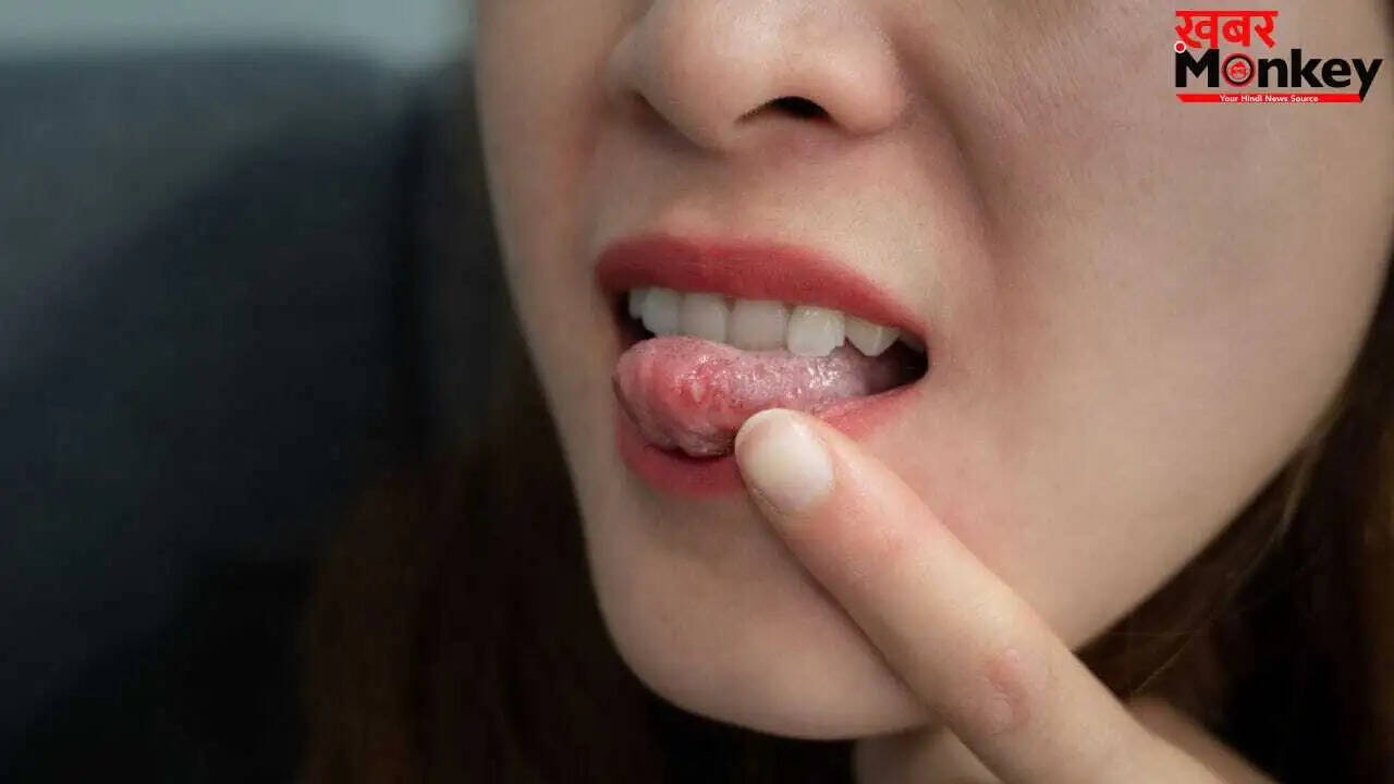 जीभ पर छालों के कारण और बचाव के उपाय