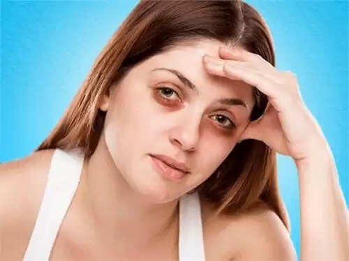 डार्क सर्कल से छुटकारा पाने के प्राकृतिक उपाय